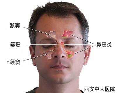 鼻窦炎的症状有哪些?